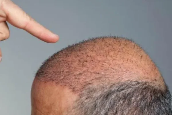 Trasplante de pelo para personas sin pelo