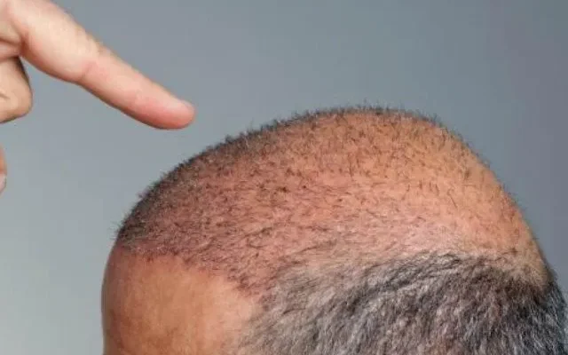 Trasplante de pelo para personas sin pelo