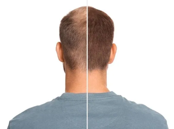 El trasplante de pelo influye en la felicidad