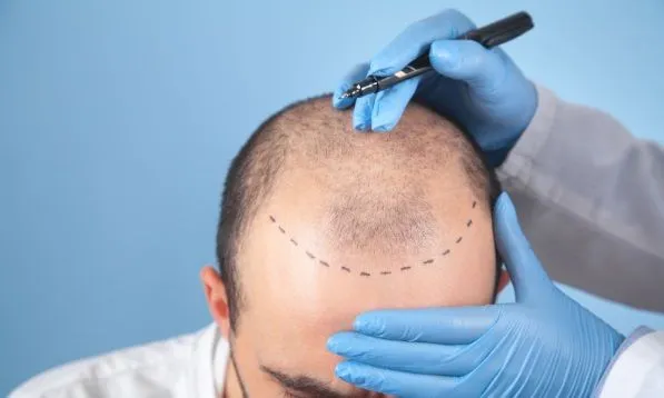 ¿Existe cura para la calvicie? 7 ¿Existe cura para la calvicie?