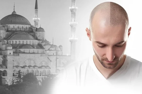 Motivos por los que escoger Turquía para hacerse un trasplante capilar