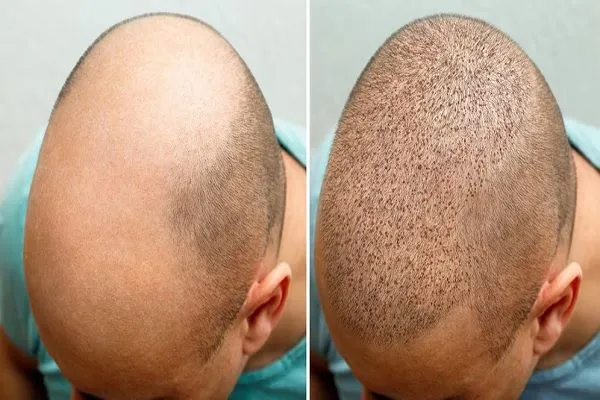 ¿Cuánto cuesta un trasplante de pelo en España? 2 ¿Cuánto cuesta un trasplante de pelo en España?