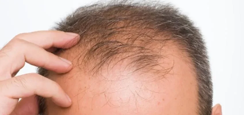 ¿Cuál es el mejor país para un trasplante de pelo? 1 ¿Cuál es el mejor país para un trasplante de pelo?