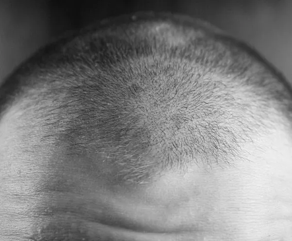 Caída del cabello desde el inicio de los tiempos
