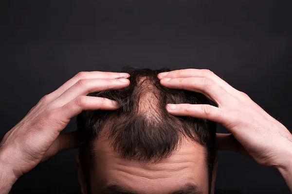¿Cómo tratar la alopecia en jóvenes?
