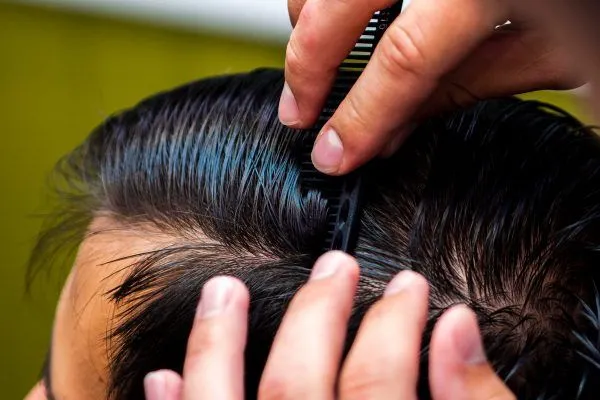 Il miglior trattamento per l’alopecia androgenetica 2 Il miglior trattamento per l’alopecia androgenetica