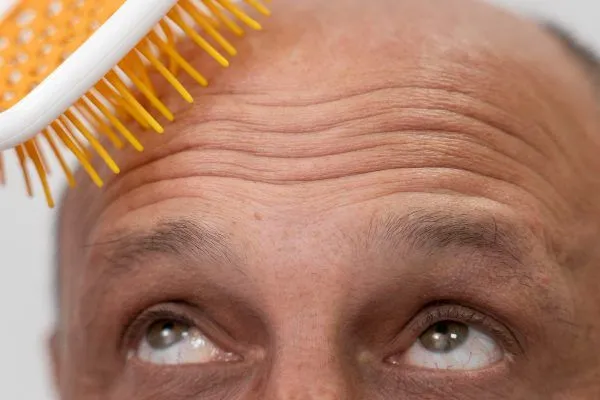 A che età i capelli di solito iniziano a cadere 2 A che età i capelli di solito iniziano a cadere