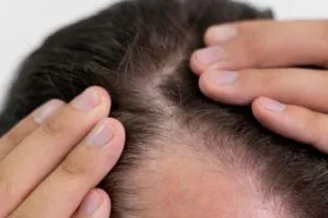 Perché mi prude la testa e mi cadono i capelli?