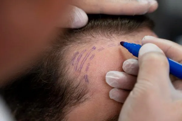 La migliori cliniche trapianto capelli Italia: Consigli e domande frequenti