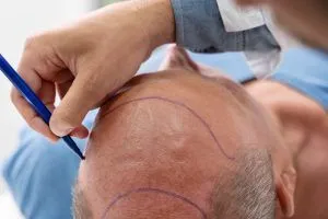 La migliore clinica trapianto capelli Turchia: Come sceglierla?