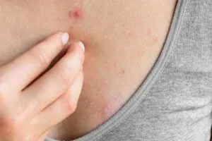 Lichen planus pilare: sintomi, cause e come curarlo