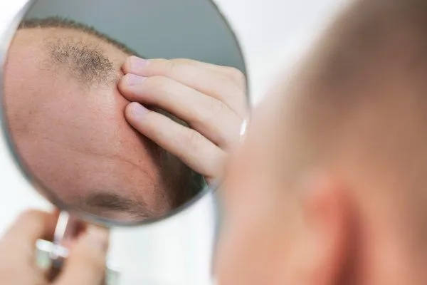 Quali sono le cause della caduta dei capelli negli uomini? 3 Quali sono le cause della caduta dei capelli negli uomini?