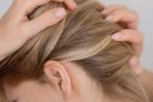 Perché mi prude la testa e mi cadono i capelli?