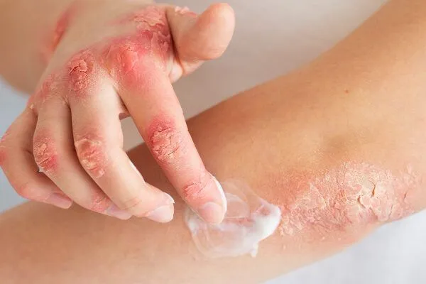 Lichen planus pilare: sintomi, cause e come curarlo