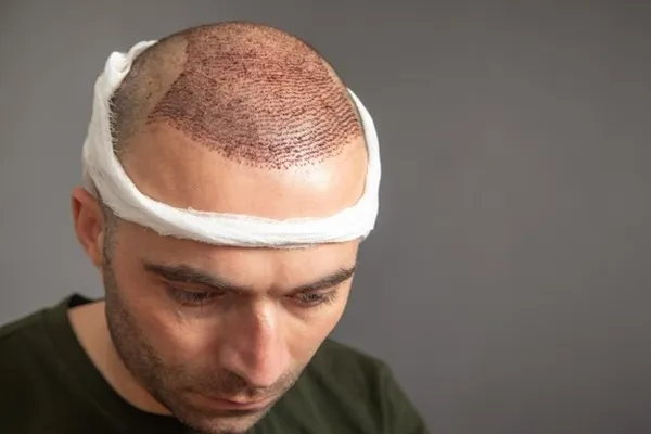 Greffe de cheveux Istanbul : pourquoi cette destination conquiert les patients européens 3 Greffe de cheveux Istanbul : pourquoi cette destination conquiert les patients européens