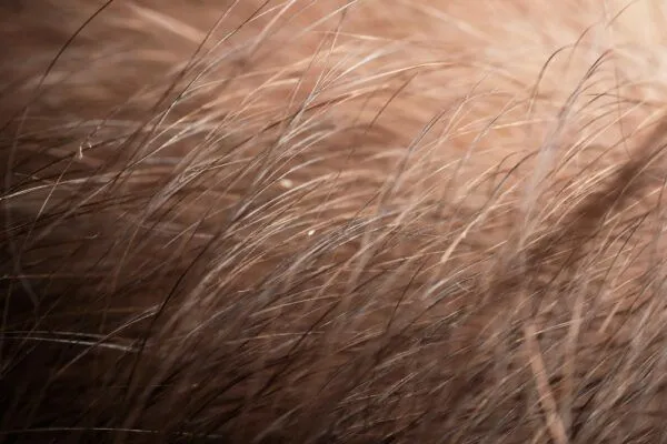 Come curare le scottature del cuoio capelluto?