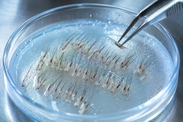 La migliori cliniche trapianto capelli Italia: Consigli e domande frequenti