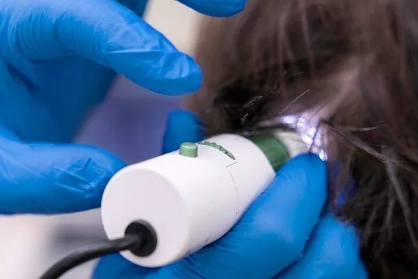 Trattamenti per l’Alopecia Areata: Cure Mediche e Terapie Disponibili 4 Trattamenti per l’Alopecia Areata: Cure Mediche e Terapie Disponibili