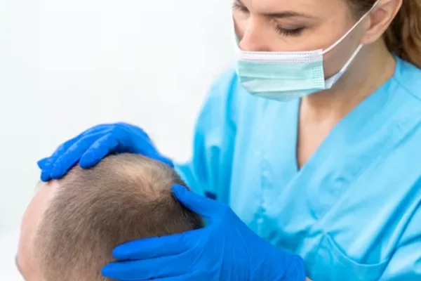 Greffe de cheveux : nombre de UF par zone à couvrir