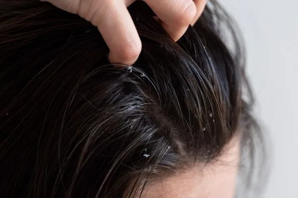 I prodotti per fissare i capelli causano l’alopecia? 6 I prodotti per fissare i capelli causano l’alopecia?