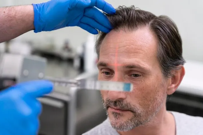 L’intelligence Artificielle révolutionne-t-elle vraiment la greffe de cheveux ?