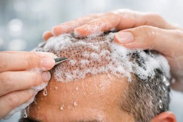 L’evoluzione di un trapianto di capelli giorno per giorno 5 L’evoluzione di un trapianto di capelli giorno per giorno