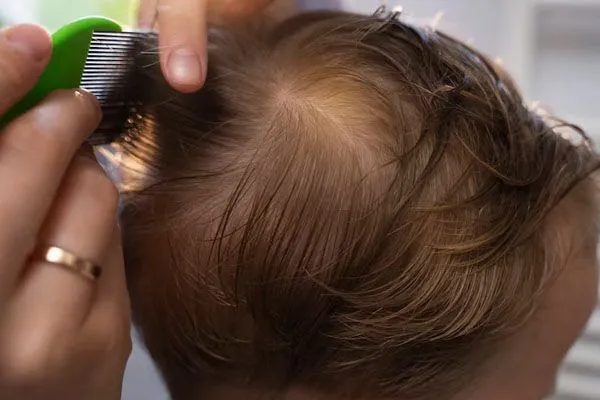 Alopecia nei bambini, è possibile?