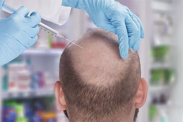 Greffe de Cheveux : Qu’est-ce que la Technique MicroFUE ? 5 Greffe de Cheveux : Qu’est-ce que la Technique MicroFUE ?