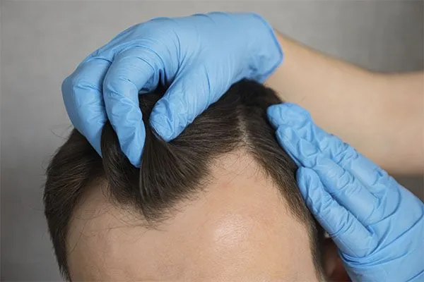 Greffe de Cheveux : Qu’est-ce que la Technique MicroFUE ? 4 Greffe de Cheveux : Qu’est-ce que la Technique MicroFUE ?