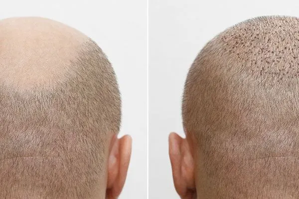 Greffe de Cheveux : Qu’est-ce que la Technique MicroFUE ? 2 Greffe de Cheveux : Qu’est-ce que la Technique MicroFUE ?