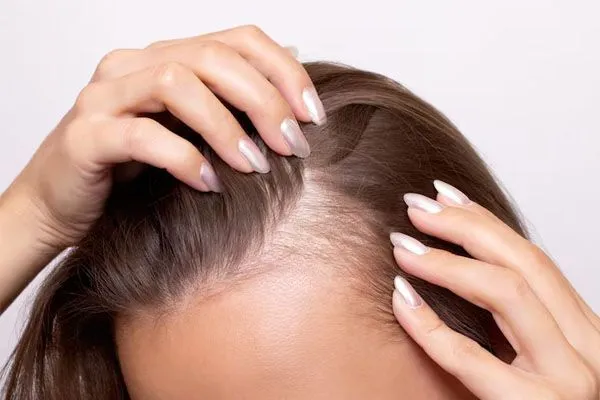 Mesoterapia per capelli: a cosa serve? 2 Mesoterapia per capelli: a cosa serve?