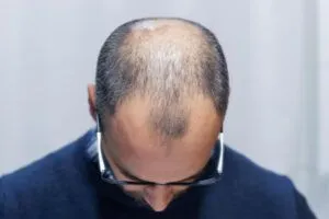 Perché mi cadono i capelli e quando preoccuparmi