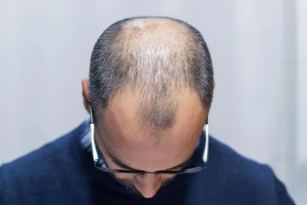 Lambdapil per la caduta dei capelli