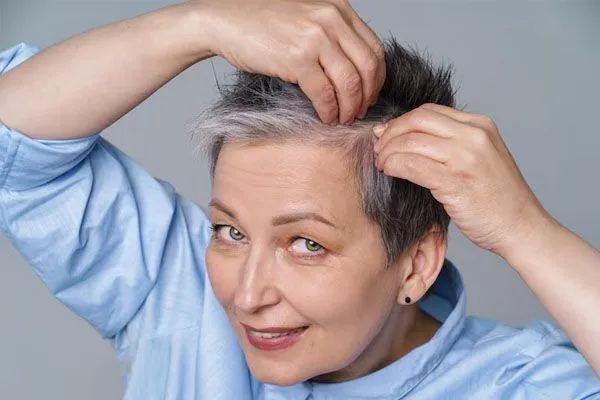 Alopecia androgenetica nelle giovani donne