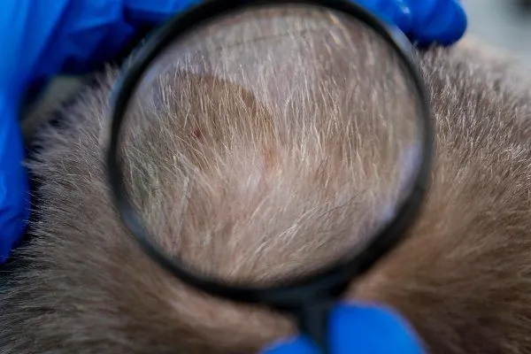 Trattamenti per l’Alopecia Areata: Cure Mediche e Terapie Disponibili 3 Trattamenti per l’Alopecia Areata: Cure Mediche e Terapie Disponibili