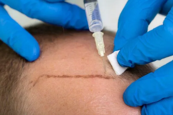Quando si vedono i risultati di un PRP per capelli? 3 Quando si vedono i risultati di un PRP per capelli?
