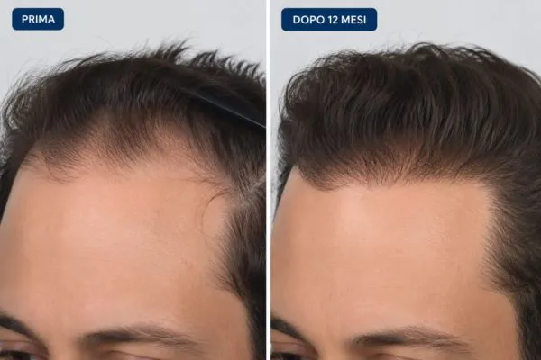 Chi è il miglior medico mondo per effettuare un trapianto di capelli? 6 Chi è il miglior medico mondo per effettuare un trapianto di capelli?