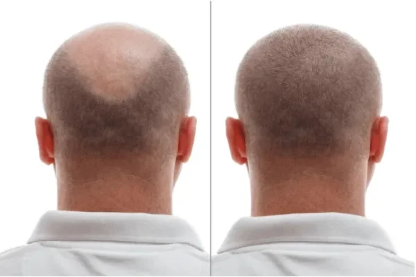 Perché sempre più Spagnoli si fanno impiantare i capelli