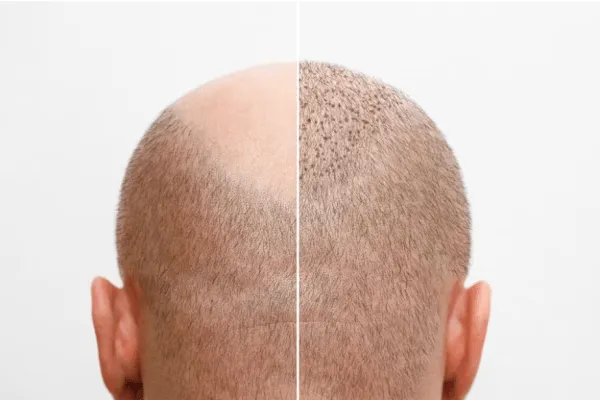 Sto diventando calvo, cosa posso fare? 4 Sto diventando calvo, cosa posso fare?
