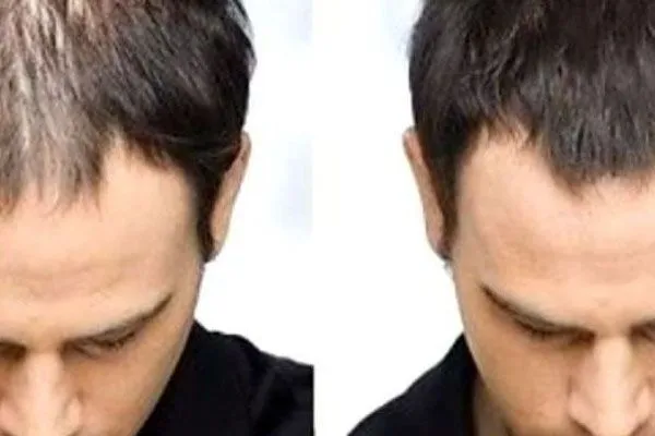 Trapianto capelli Roma, qual è la migliore clinica?