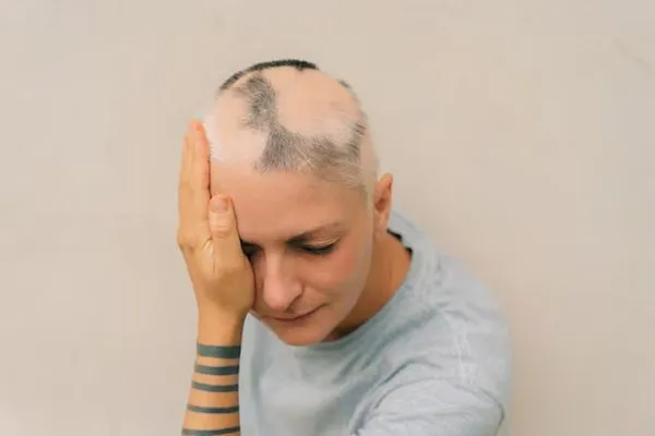 Trattamenti per l’Alopecia Areata: Cure Mediche e Terapie Disponibili