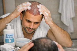Trattamento medico dopo un trapianto di capelli