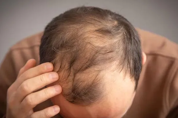 Alopecia androgenetica: una sfida condivisa tra uomini e donne 1 Alopecia androgenetica: una sfida condivisa tra uomini e donne