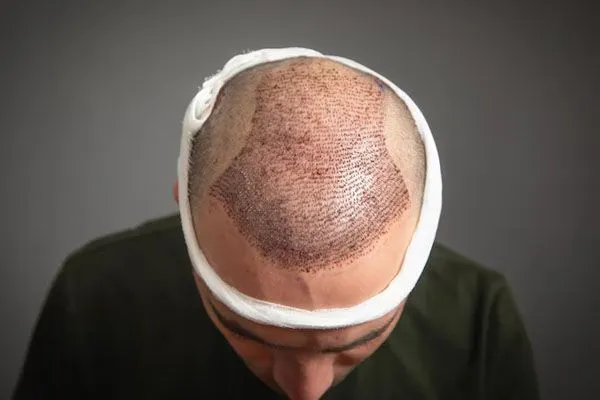 Perché mi cadono i capelli e quando preoccuparmi