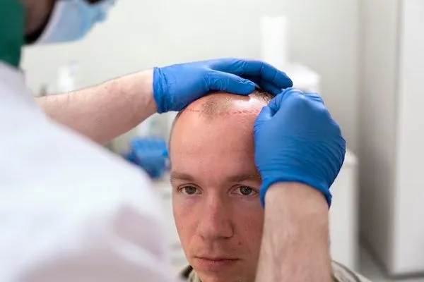 Le meilleur traitement pour l’alopécie androgénétique