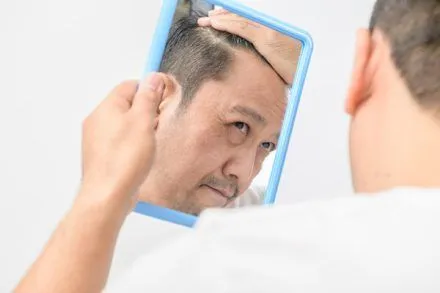 Cos’è ormone DHT e caduta dei capelli