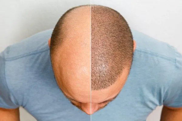 Come recuperare i capelli?