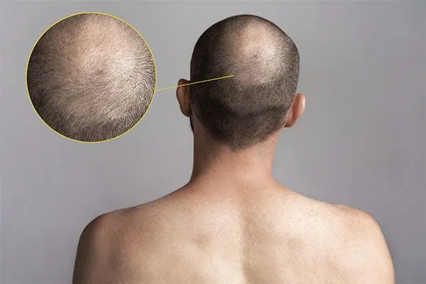 Quelle est la meilleure solution pour la calvitie? 2 Quelle est la meilleure solution pour la calvitie?