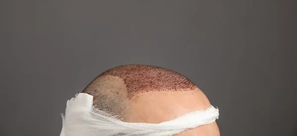 Come scegliere un buon chirurgo per il trapianto di capelli 3 Come scegliere un buon chirurgo per il trapianto di capelli