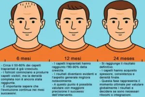 Postoperatorio del trapianto di capelli 2 Postoperatorio del trapianto di capelli